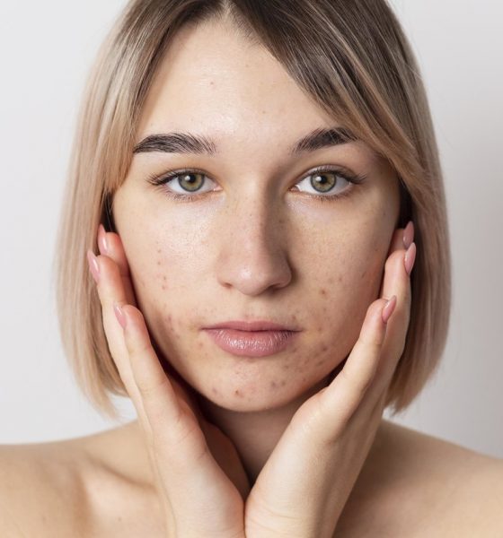 Clínica Acessível Goiânia - Você conhece os mitos e verdades sobre a acne?