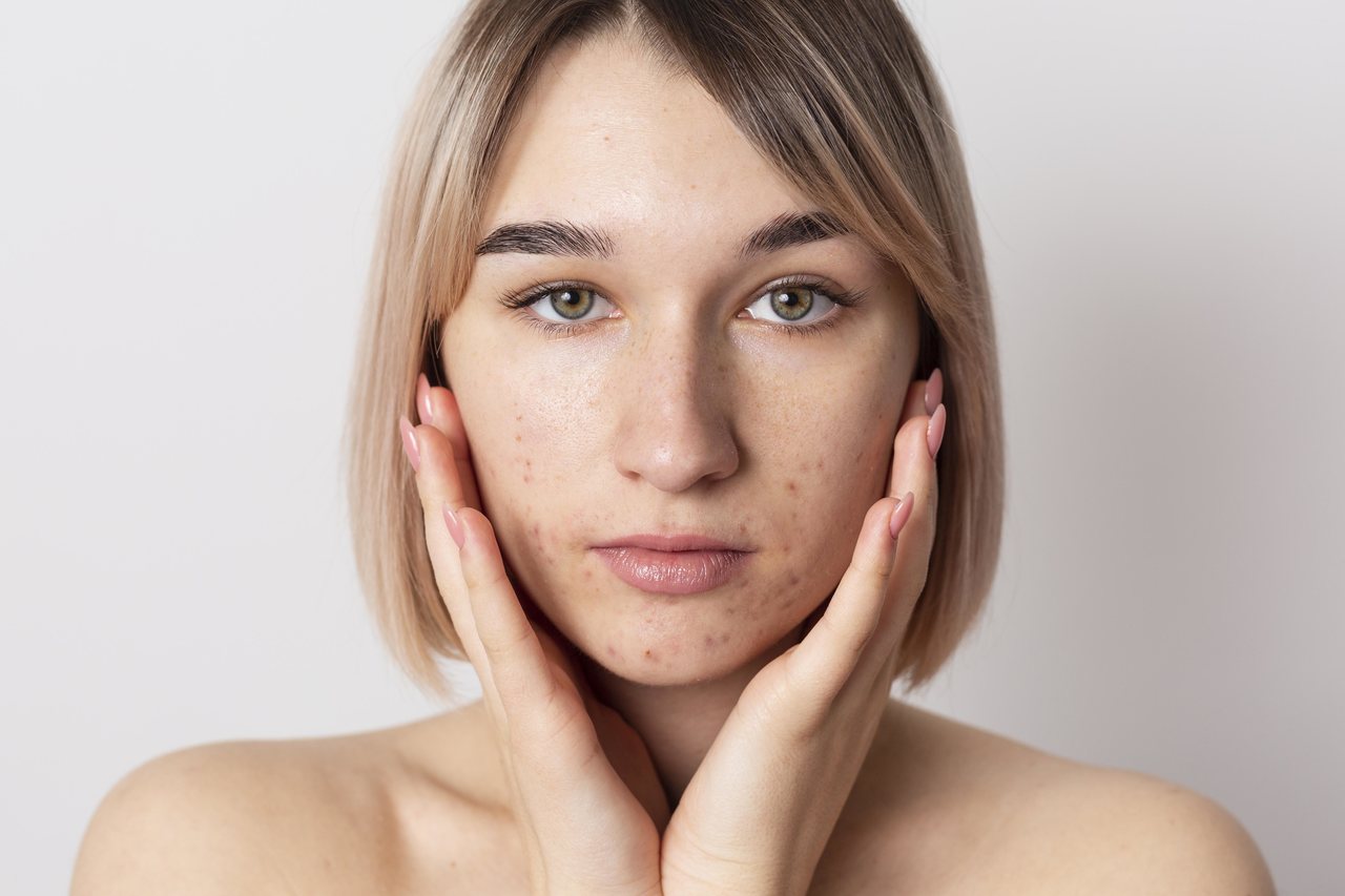 Clínica Acessível Goiânia - Você conhece os mitos e verdades sobre a acne?