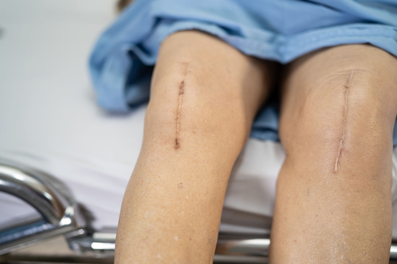 Pronto Socorro para Queimaduras - Conheça os tipos de cicatrizes