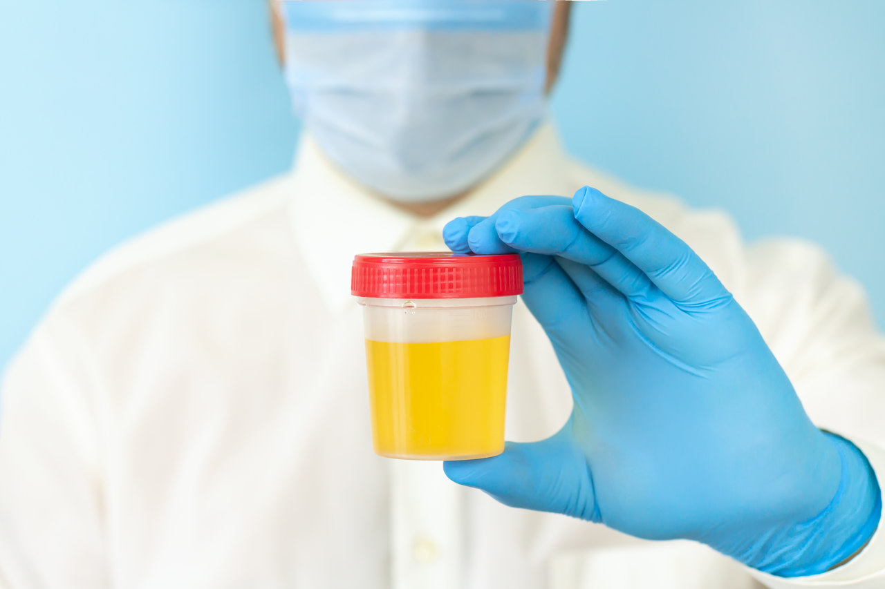 Urologia Goiânia - Sangue na urina: o que pode ser?