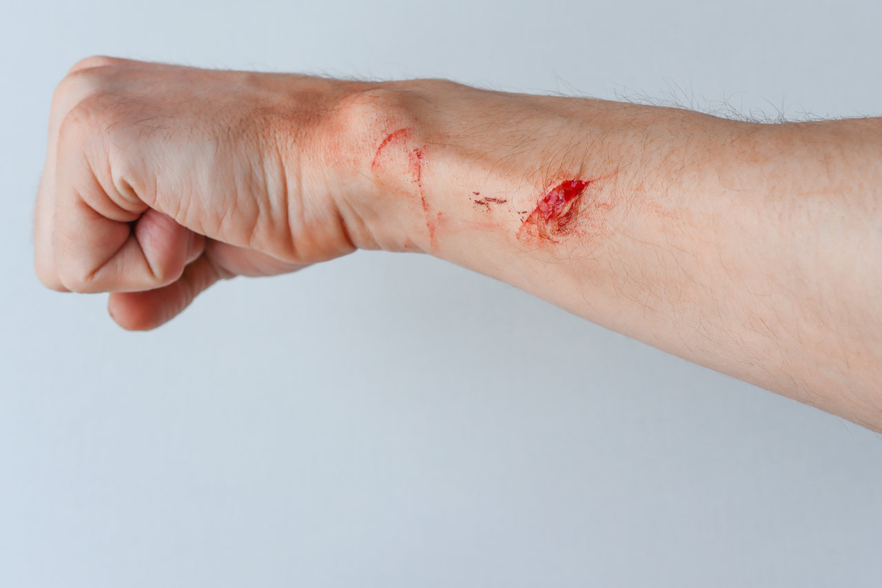 Pronto Socorro para Queimaduras - Tipos de tecidos encontrados em uma lesão