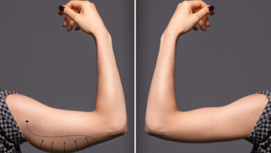 Você conhece a cirurgia plástica para melhorar o braço do tchauzinho?