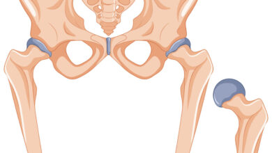 Clinica Ortopédica Goiânia - Conheça os tipos de Artroplastia de Quadril