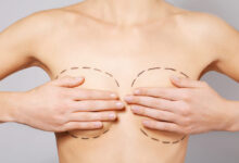 Cirurgia Plástica Goiânia - Conheça os tipos de mamoplastia