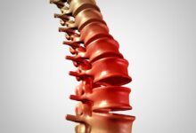 Clinica Ortopédica Goiânia - Qual a diferença entre escoliose, lordose e cifose?