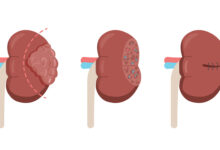 Clínica Urologia de Goiânia - Quando indicar Nefrectomia Parcial Robótica