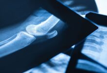 Ortopedia Goiânia - Quando é indicada a radiografia do joelho