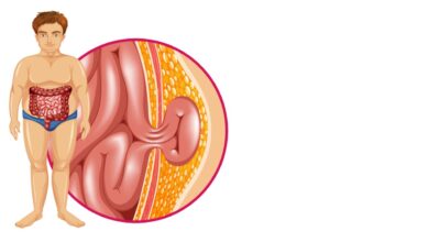 Urologia goiânia - Hérnia inguinal Tudo que você precisa saber sobre a cirurgia!