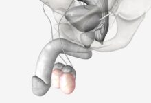 Urologista Aparecida de Goiânia - Torção testicular uma emergência urológica