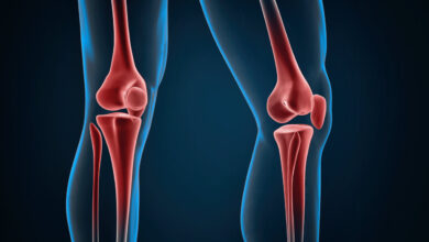 Ortopedia Goiânia - Joelho torto é sinal de alerta! Entenda a Osteotomia
