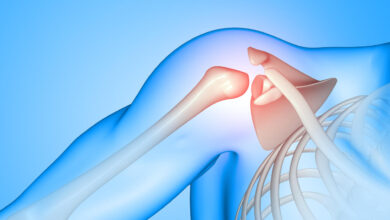 Ortopedia Goiânia - Tendinite do Manguito Rotador quais os sintomas