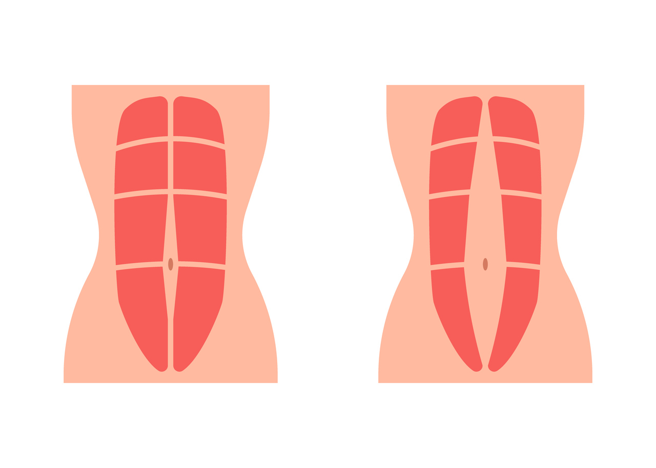 Cirurgia Plástica Goiânia - O que é e quando fazer a correção de diástase?