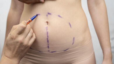 Cirurgia Plástica Goiânia - Tipos de cicatriz da abdominoplastia