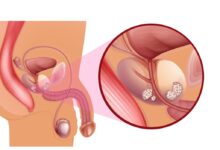 Urologia Goiânia - Novembro Azul - Cuide-se e previna-se contra o câncer de próstata!