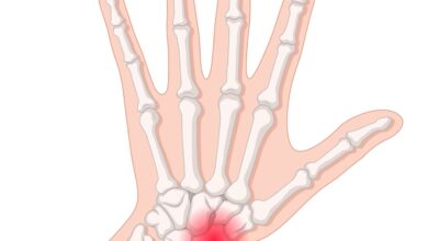 Ortopedia Goiânia - Quais as causas de fratura do escafoide