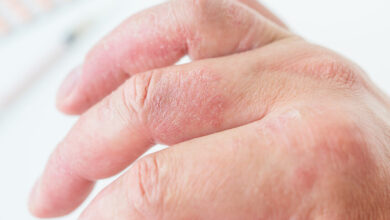 10 causas mais comuns de inchaço nas mãos