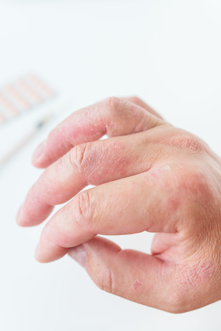 10 causas mais comuns de inchaço nas mãos