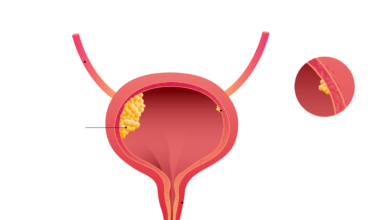 Urologia Goiânia - Por que a prostatectomia radical robótica é tão eficaz?