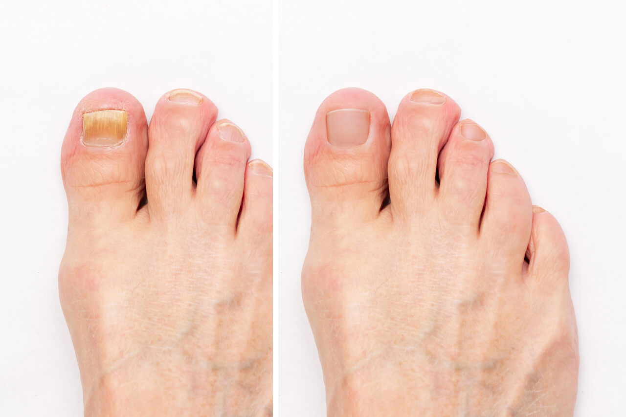 Ortopedia Goiânia - Deformidades nos dedos: causas e tratamentos