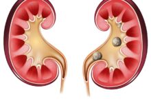 Ureterorrenolitotripsia rígida: conheça os benefícios dessa cirurgia