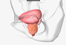 Urologia Goiânia - RTU de próstata: cirurgia de próstata que corrige prejuízos no fluxo de urina
