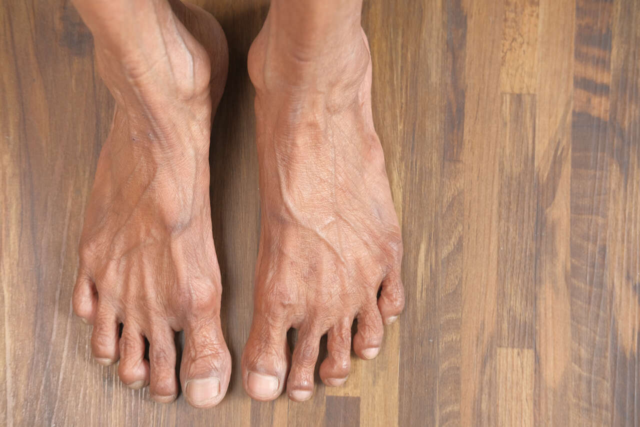 Residencial para Idosos Goiânia - Cuidados essenciais a ter com os pés dos idosos