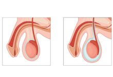 Urologia Goiânia - Qual o tratamento cirúrgico da hidrocele?
