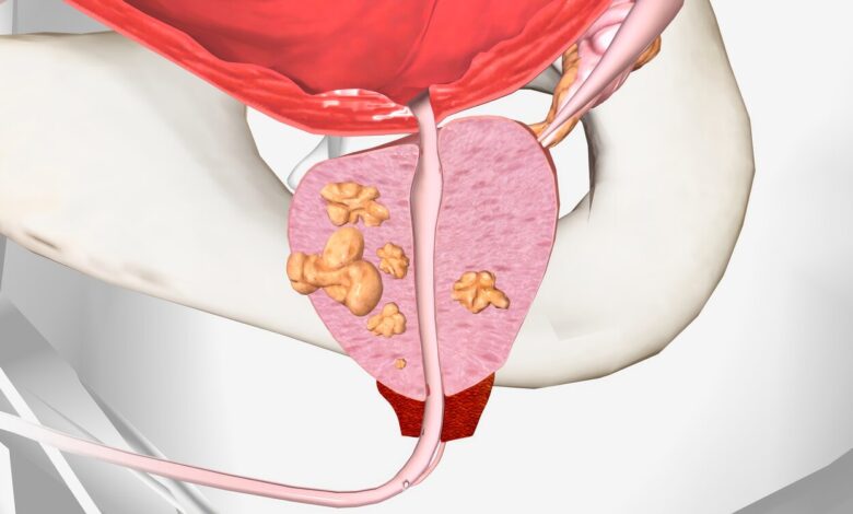 Urologia Goiânia - Todo câncer de próstata precisa de cirurgia?