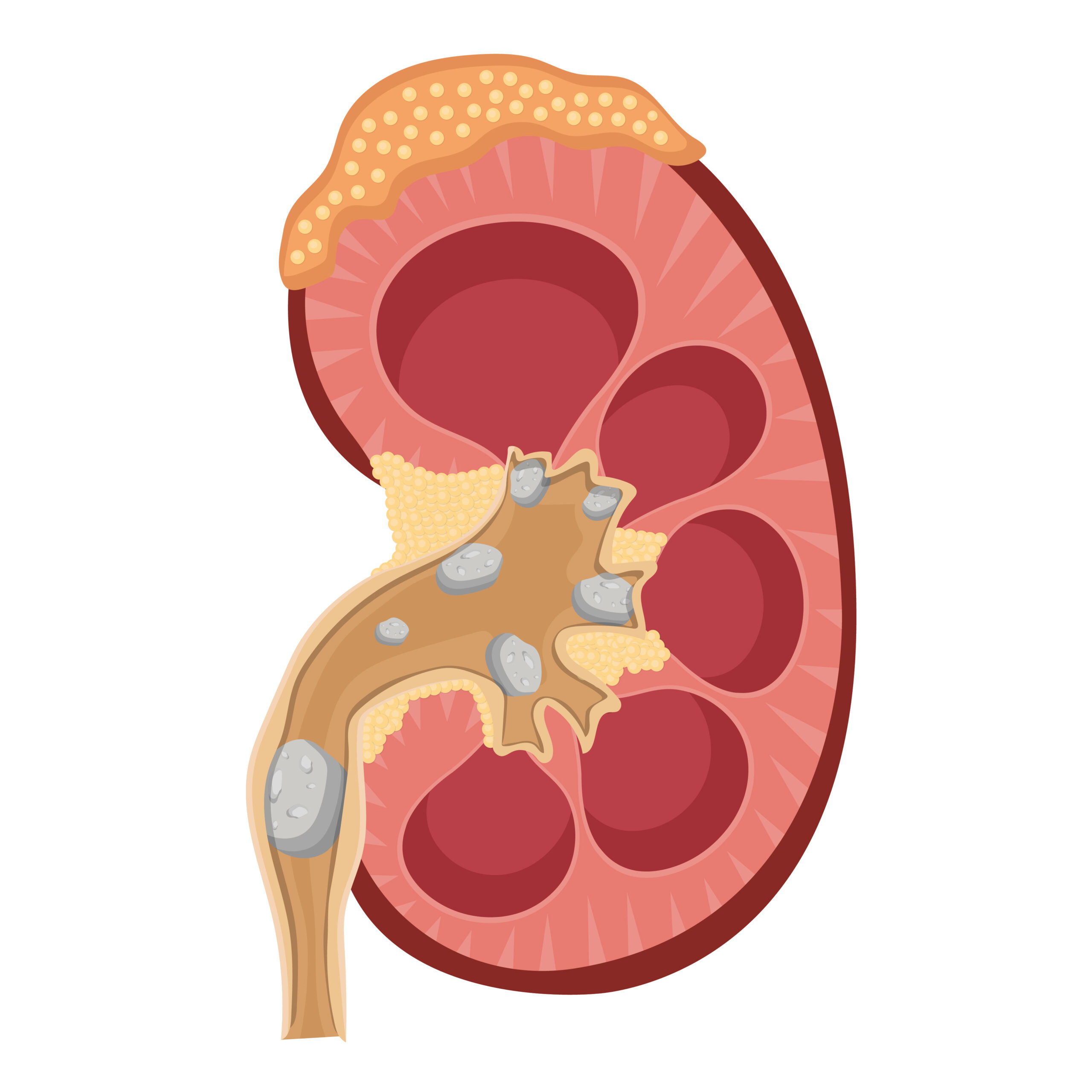 Urologia Goiânia - 5 curiosidades sobre pedras nos rins!