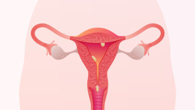 Importância de diagnosticar pólipos uterinos que acometem 40% das mulheres!