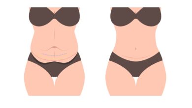 Você sabe a diferença entre abdominoplastia e mini abdominoplastia?