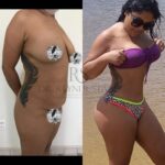 Dr Reyner Stival Brasília Mastopexia e Abdominoplastia