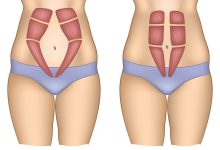 https://folhadegoias.info/wp-content/uploads/2024/12/2-E-possivel-corrigir-a-diastase-abdominal-sem-realizar-uma-abdominoplastia.jpg