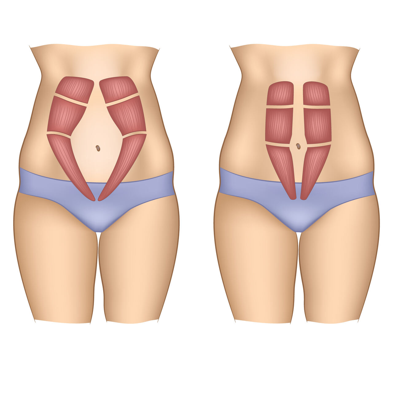 https://folhadegoias.info/wp-content/uploads/2024/12/2-E-possivel-corrigir-a-diastase-abdominal-sem-realizar-uma-abdominoplastia.jpg