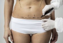 Cirurgião plástico Brasília: Como as cicatrizes evoluem ao longo do tempo e o que pode ser feito para minimizá-las?