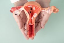 É possível ter miomas sem apresentar sintomas?
