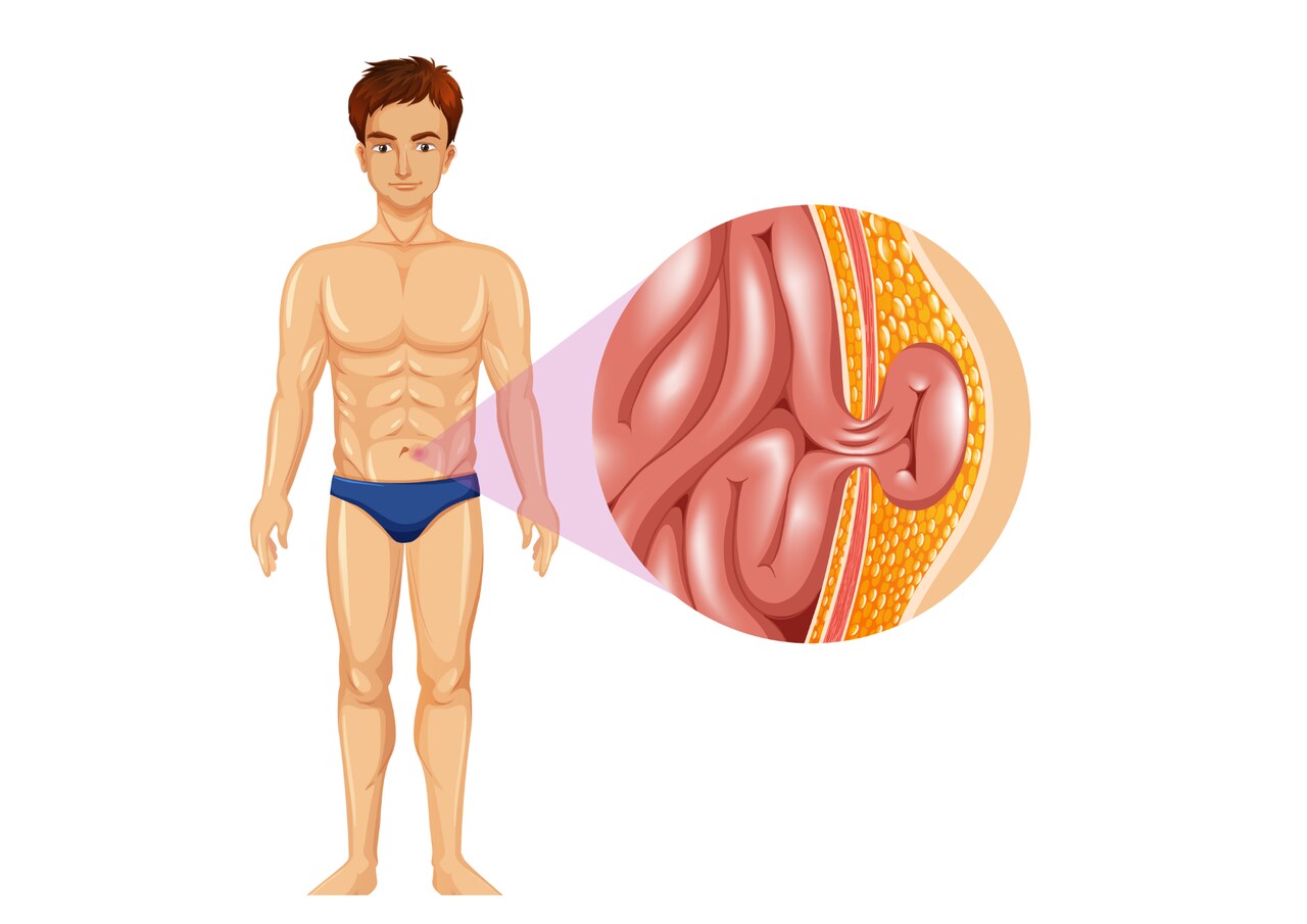 Como identificar hérnia umbilical e quando operar