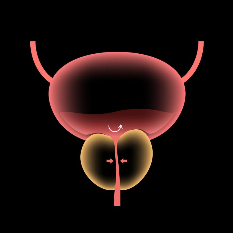 O que é HoLEP? Entenda como funciona a cirurgia da próstata com laser de hólmio