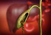 Pedra na vesícula a cirurgia é o único tratamento
