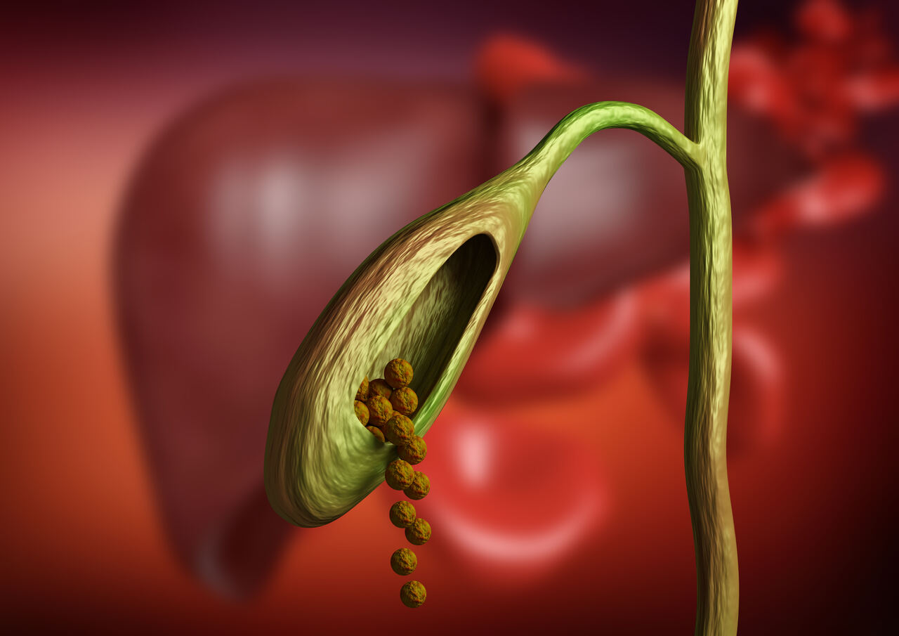 Pedra na vesícula a cirurgia é o único tratamento