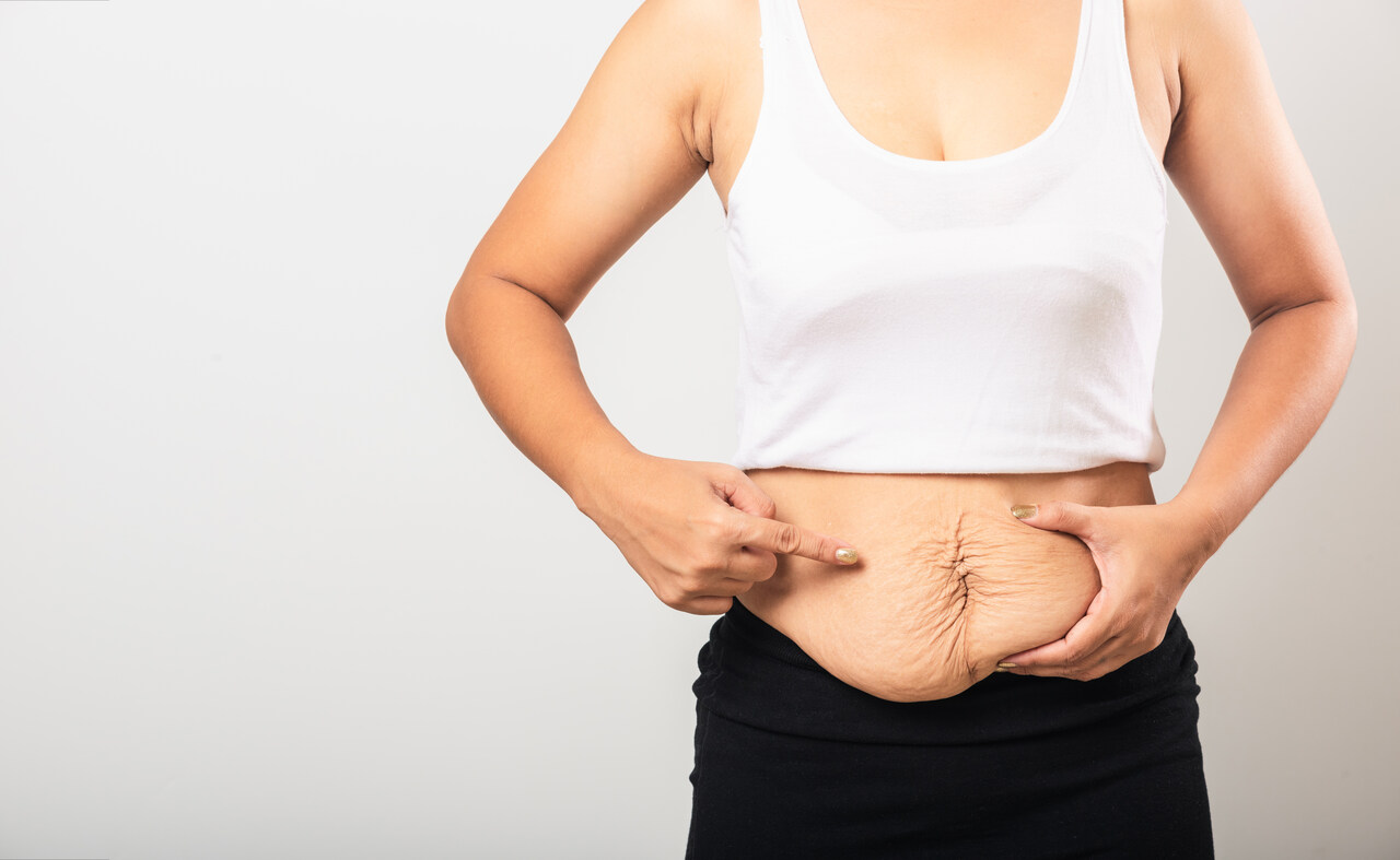 Abdominoplastia em âncora é opção indicada por Dr. Reyner Abrantes Stival para pacientes com excesso de pele em Goiânia e Brasília