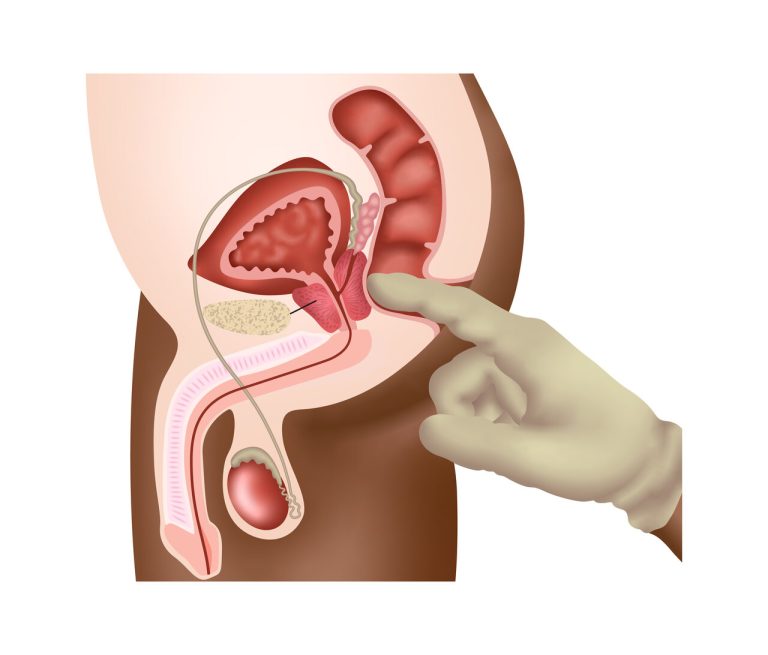 Dr. Marco Túlio Cruvinel, urologista em Goiânia, explica passo a passo como é feito o diagnóstico do câncer de próstata