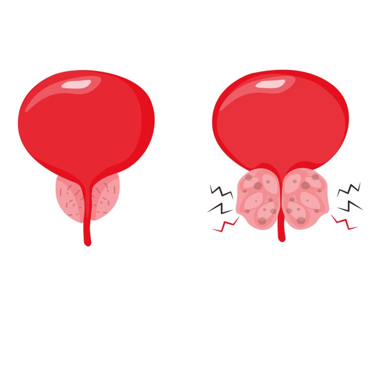 Laser HoLEP: inovação no tratamento da hiperplasia prostática benigna