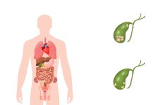 Qual a diferença entre pedra e pólipo na vesícula