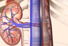Cirurgia para câncer de rim quando optar por nefrectomia parcial ou total