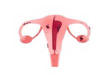 Você sabia que existem três tipos diferentes de endometriose
