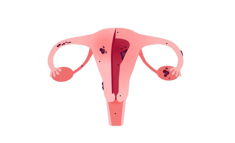 Endometriose profunda, ovariana e superficial: veja as diferenças entre os tipos