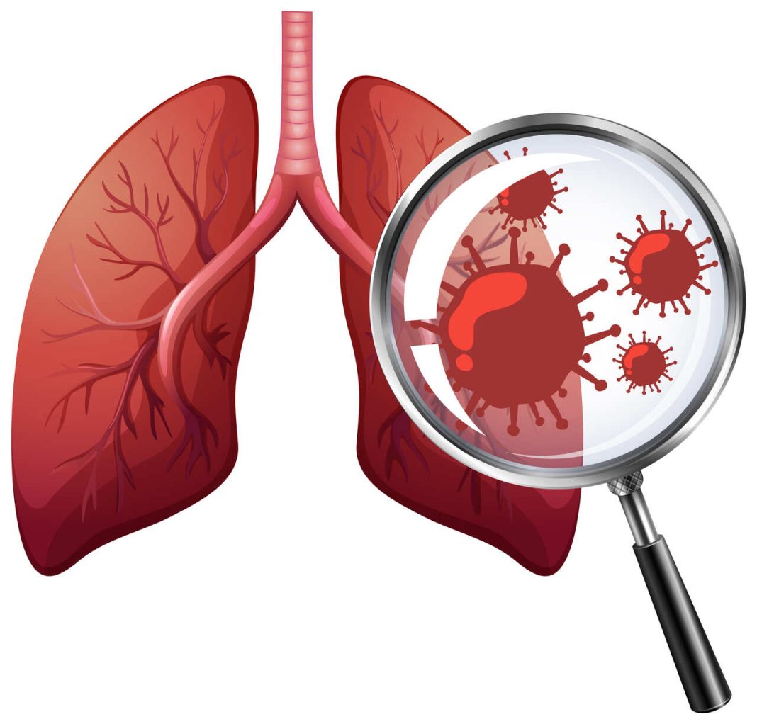 Entenda o papel da tomografia no diagnóstico da Influenza A e Vírus Sincicial Respiratório (VSR)